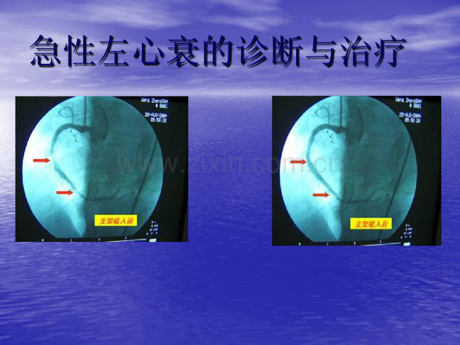 急性左心衰的诊断与治疗.pdf_第1页