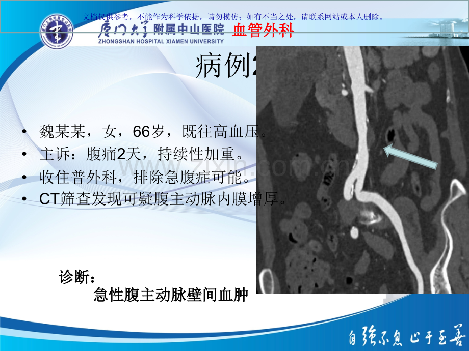 主动脉壁间血肿和穿透性溃疡课件.ppt_第2页
