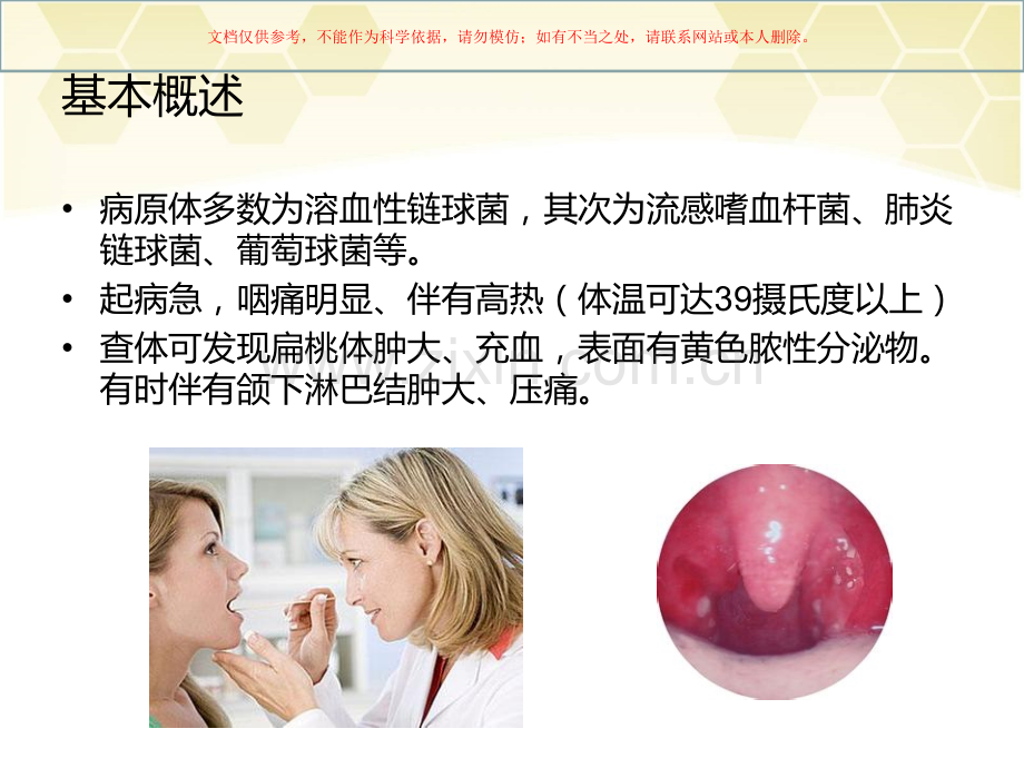 化脓性扁桃体炎课件.ppt_第1页