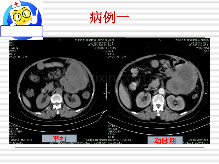 PPT医学课件胃肠道间质瘤的影像诊断讲义.ppt_第2页