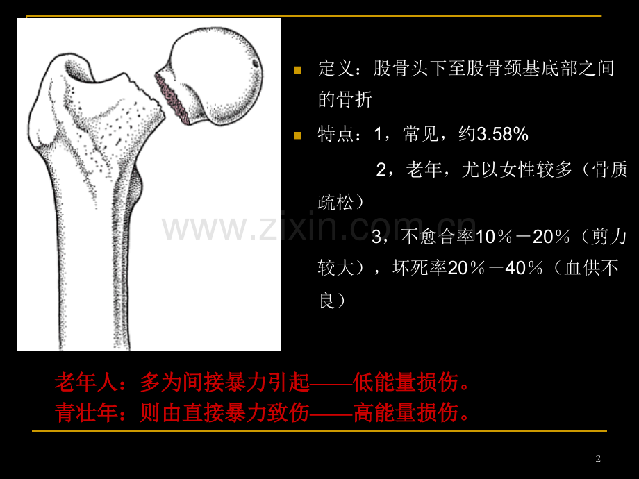 股骨颈骨折ppt1.ppt_第2页