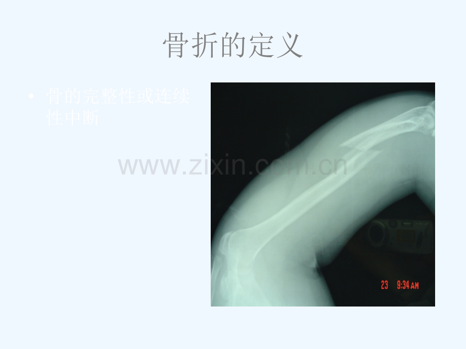 骨折的保守治疗.ppt_第2页