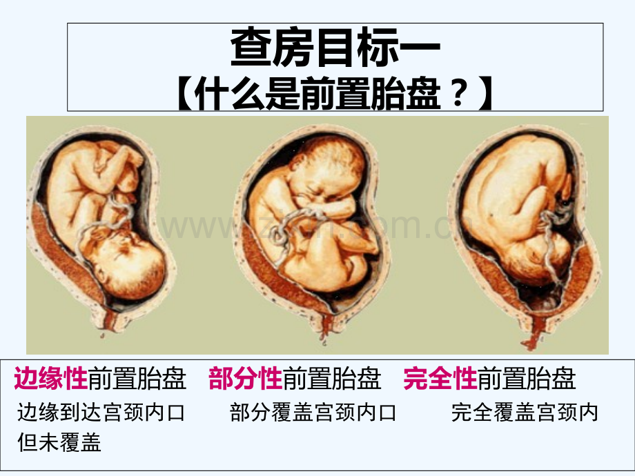 前置胎盘教学查房模板.pptx_第2页