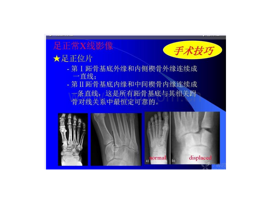 lisfrac关节损伤-医学课件.ppt_第1页