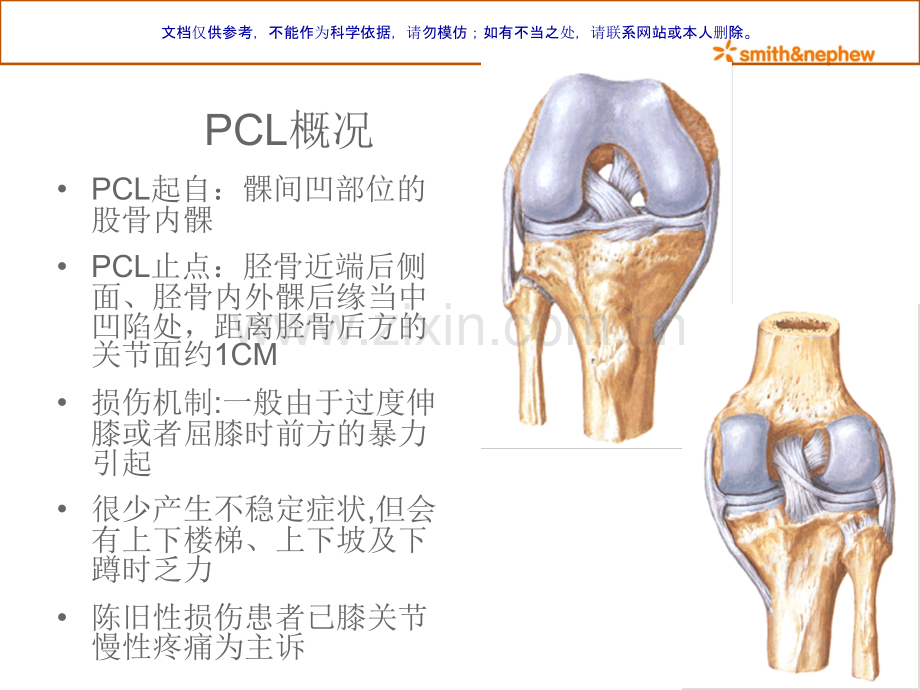 交叉韧带重建PCL重建课件.ppt_第1页
