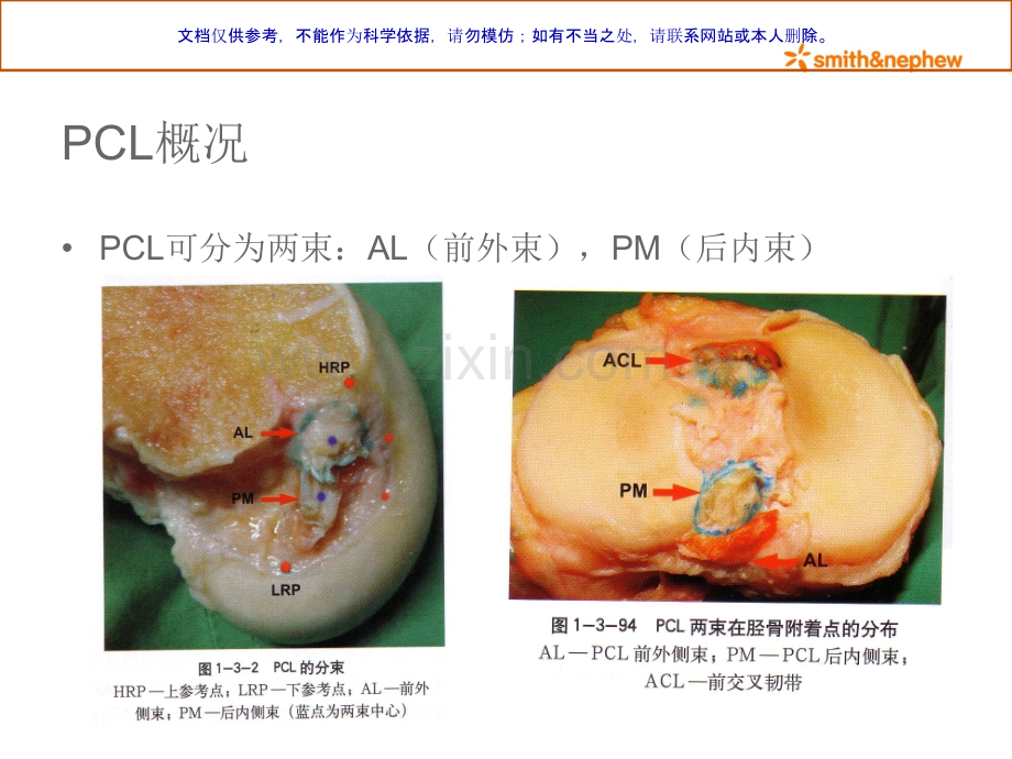 交叉韧带重建PCL重建课件.ppt_第2页