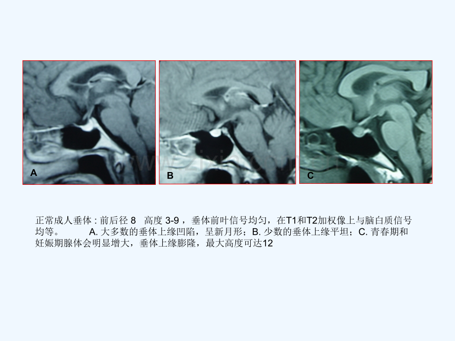 垂体微腺瘤影像与治疗策略.ppt_第2页