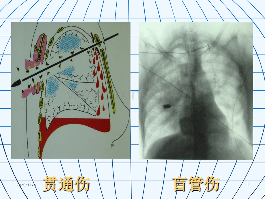 严重胸部创伤的早期判断和处理.ppt_第2页