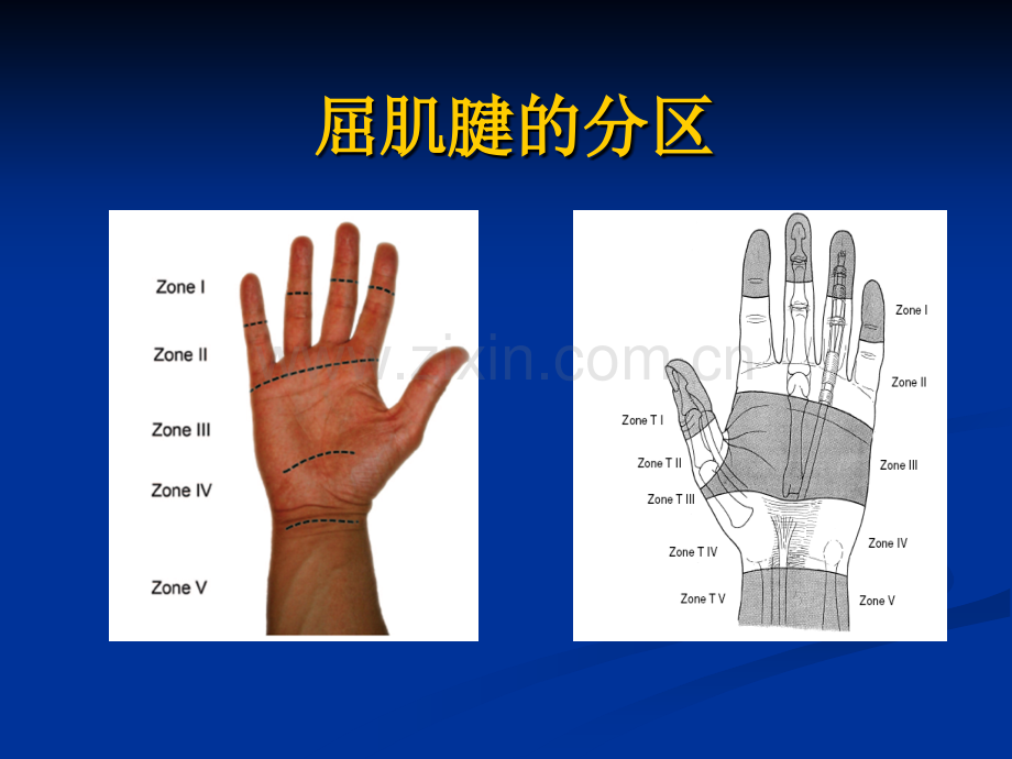 屈肌腱分区及治疗.ppt_第2页