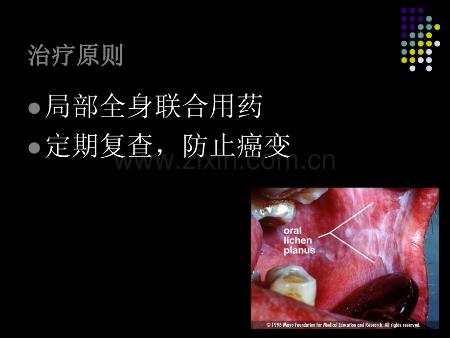 口腔扁平苔藓的治疗及预后.ppt_第2页