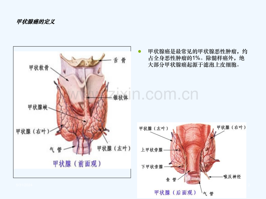 甲状腺肿瘤护理查房.ppt_第2页