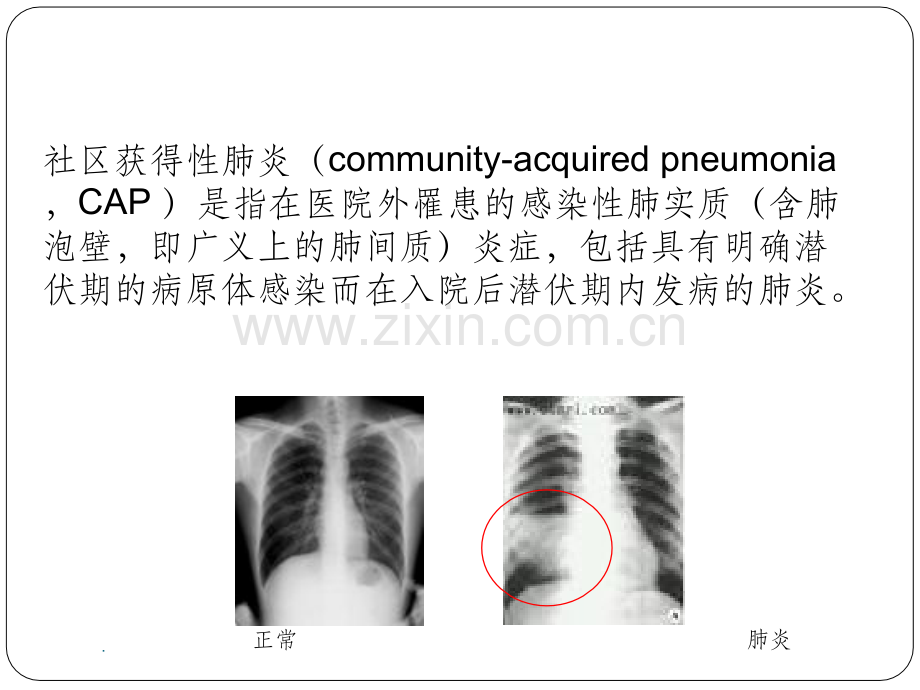 社区获得性肺炎的诊断与治疗.ppt_第2页