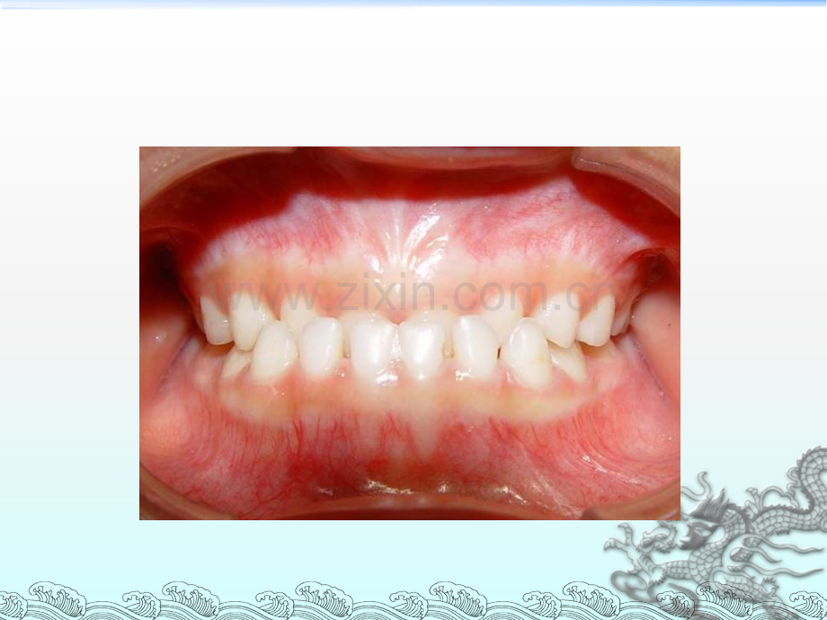 牙合畸形的早期矫治.ppt_第2页