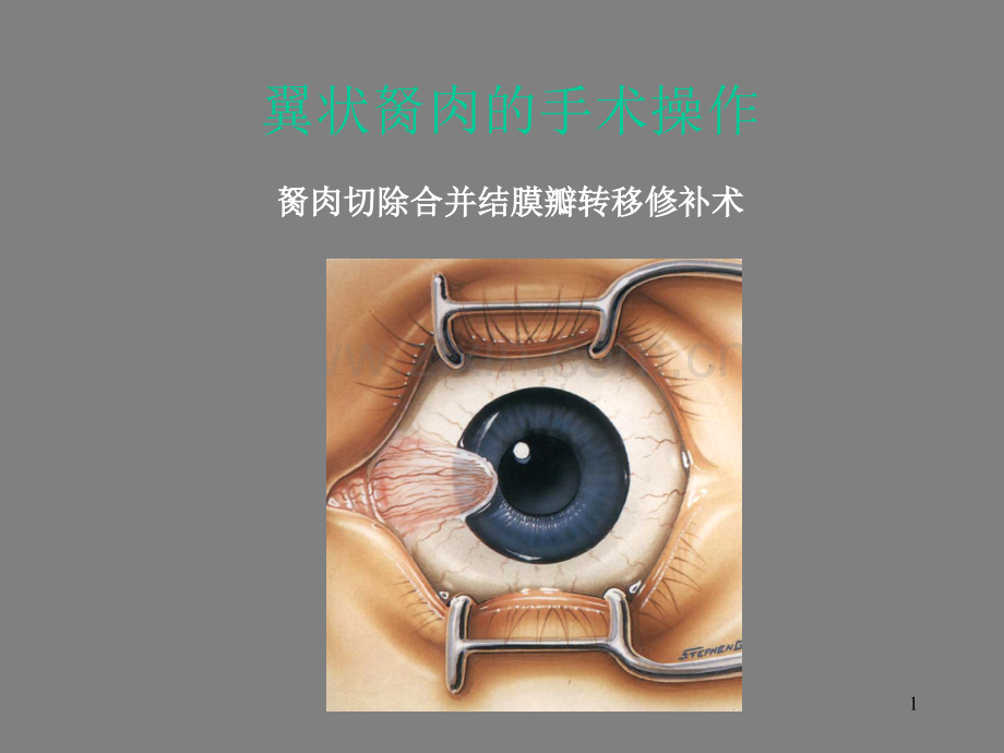 翼状胬肉的手术.ppt_第1页