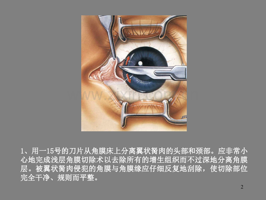 翼状胬肉的手术.ppt_第2页