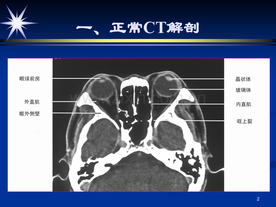 眼及眼眶影像诊断.ppt_第2页