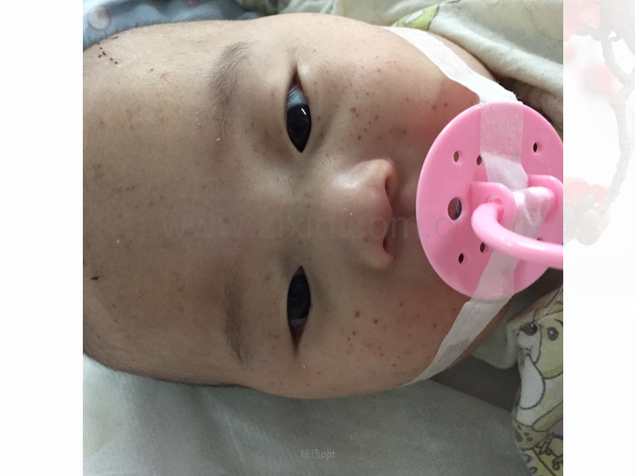 血小板减少性紫癜查房.ppt_第2页