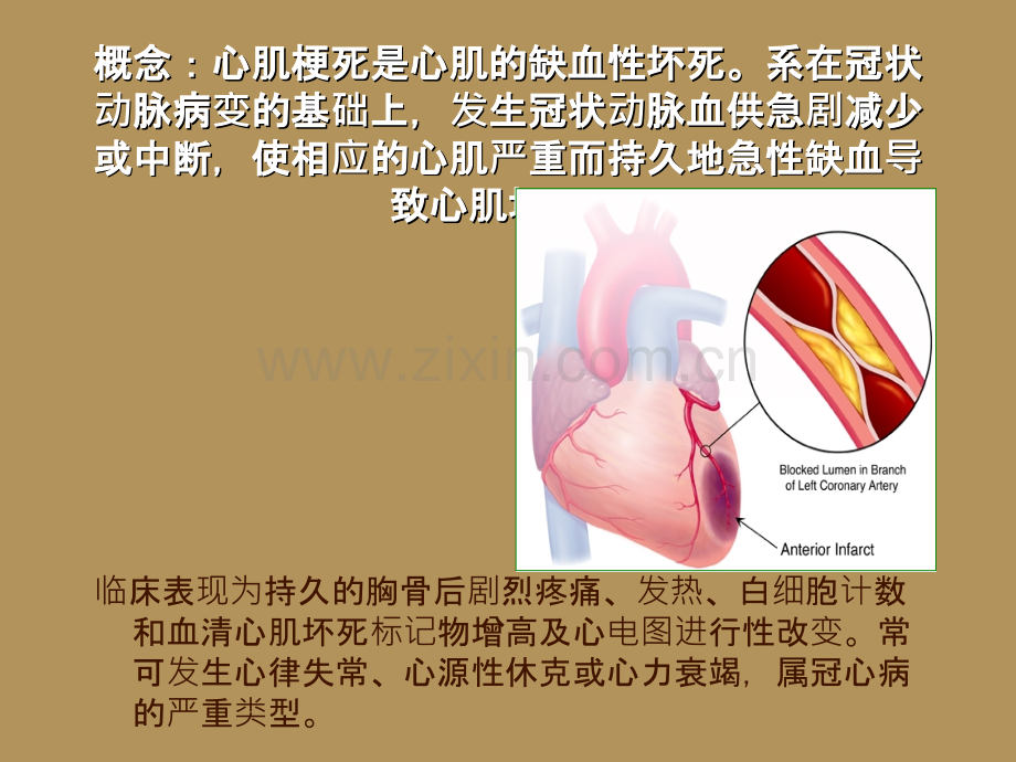 心肌梗死的护理常规.ppt_第2页