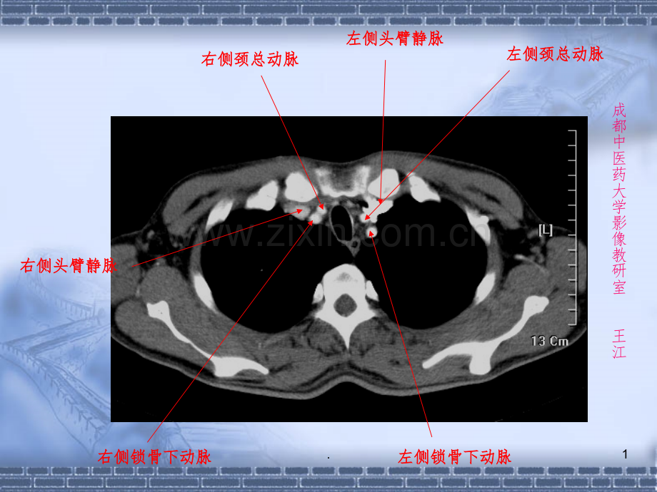 肺部CT-肺部纵隔窗.ppt_第1页