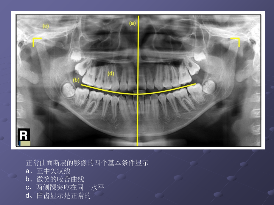 全景曲面断层中经常出现的错误图像原因.ppt_第2页