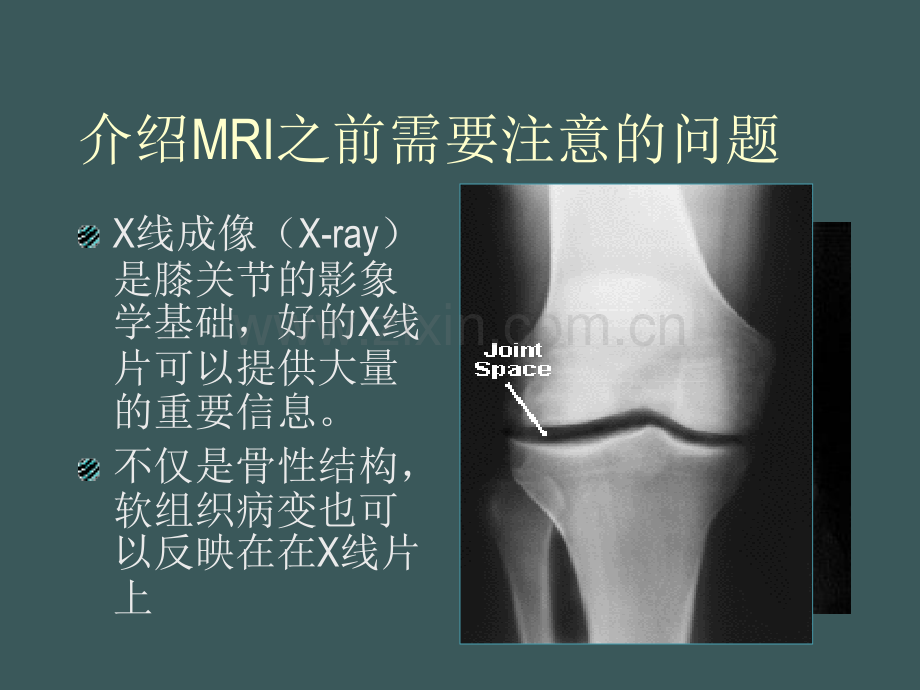 如何阅读膝关节磁共振图象.ppt_第2页