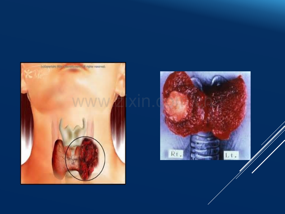 甲状腺TI-RADS分类.ppt_第2页