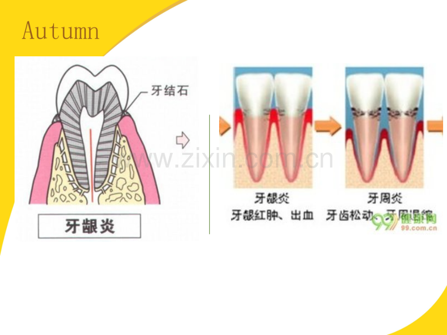 牙龈炎病人的护理.ppt_第2页