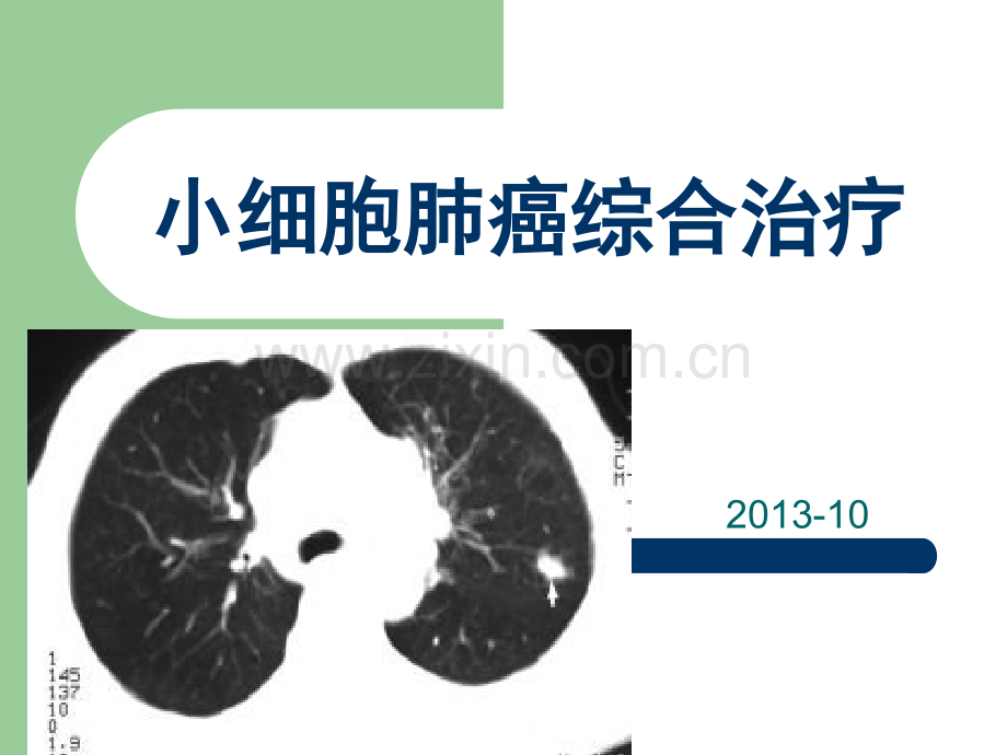 小细胞肺癌的综合治疗.ppt_第1页