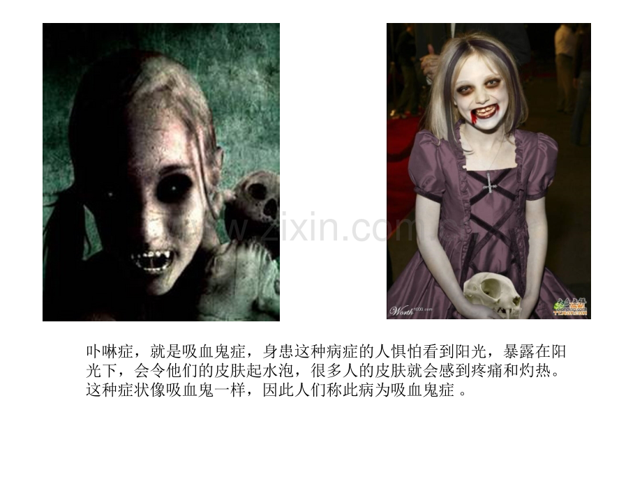 卟啉症(吸血鬼病).ppt_第2页