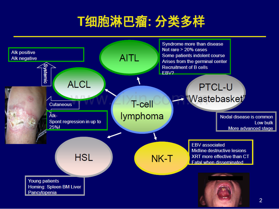 治疗外周T细胞淋巴瘤的新型药物.pptx_第2页