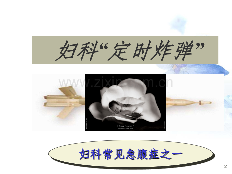 异位妊娠.ppt_第2页
