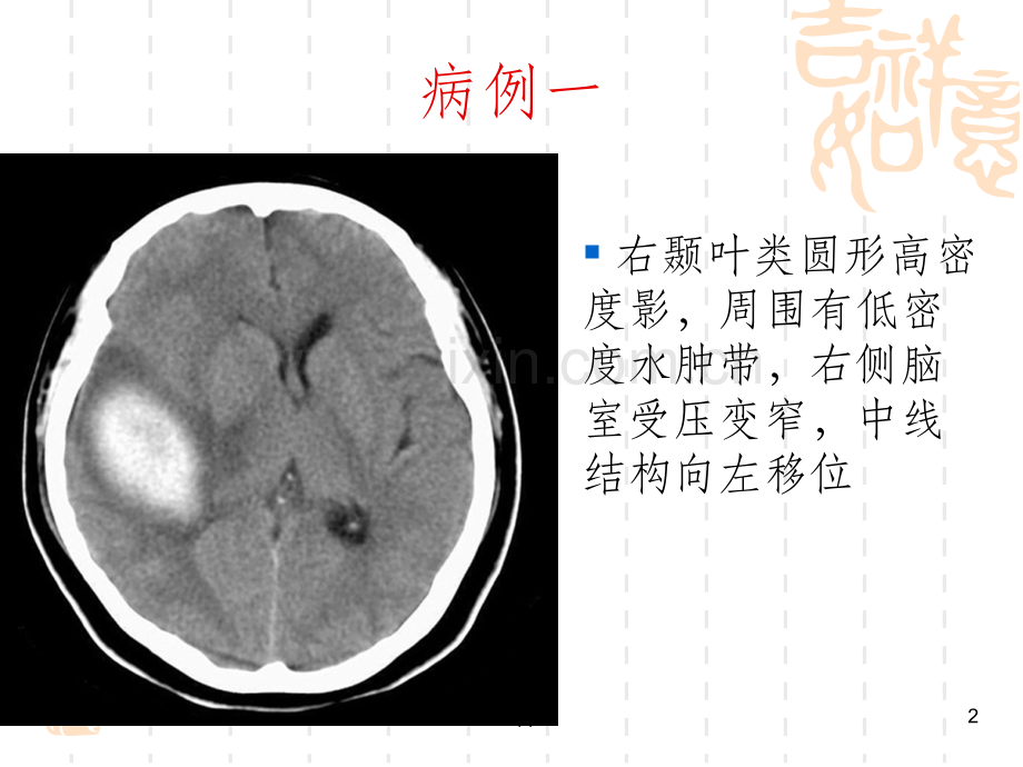 医学影像学病例讲解(MRI、CT、DR).ppt_第2页