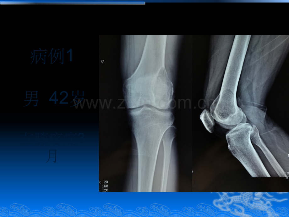 骨巨细胞瘤影像诊断.ppt_第2页
