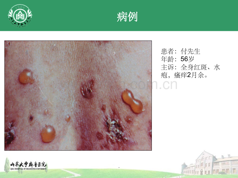 大疱性类天疱疮.ppt_第2页