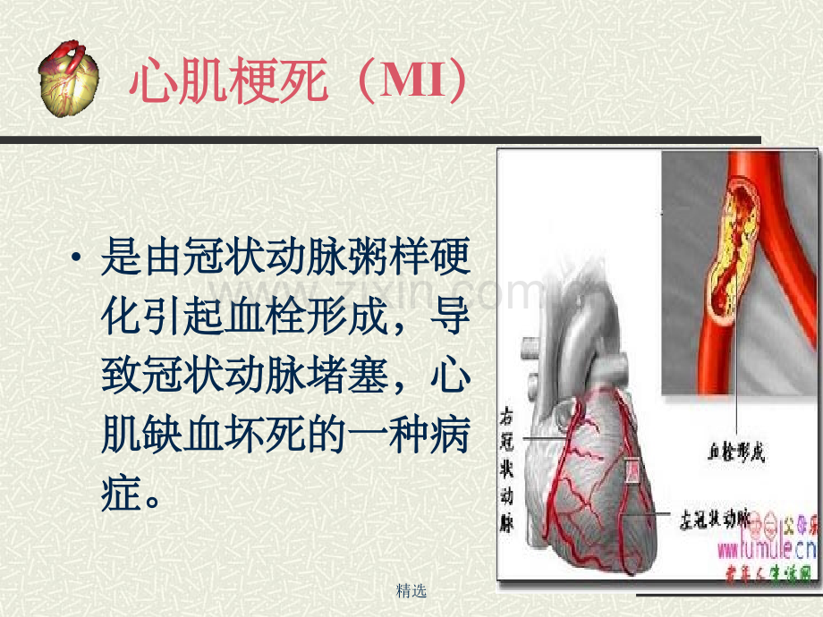 急性心肌梗死健康宣教1.ppt_第2页