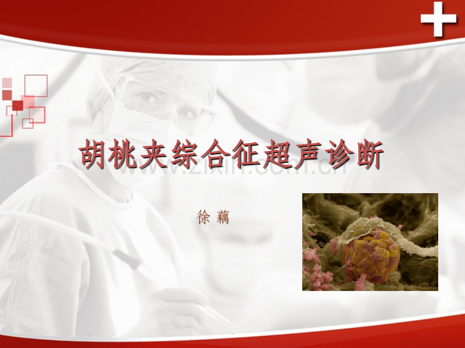 胡桃夹综合征.ppt_第1页
