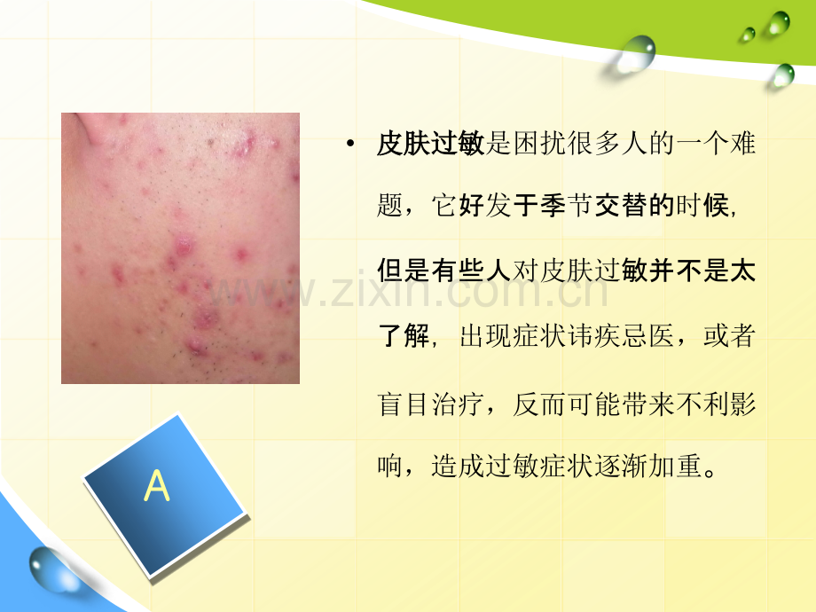 皮肤过敏皮肤过敏图片.ppt_第2页
