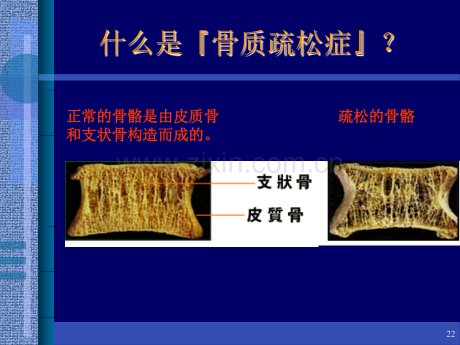 骨质疏松.ppt_第2页