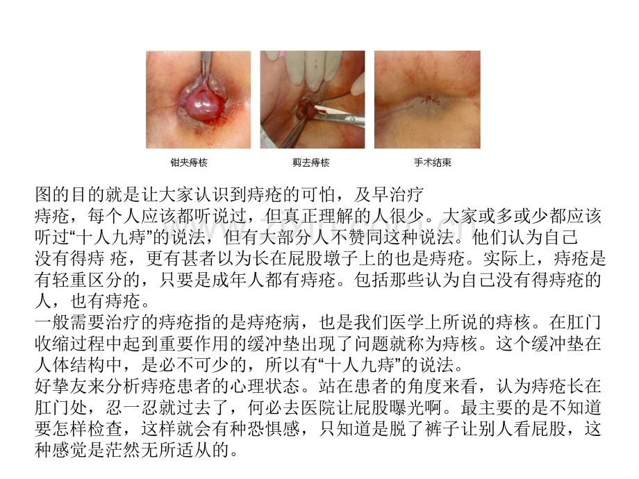 深入分析痔疮患者的心理.pptx_第2页