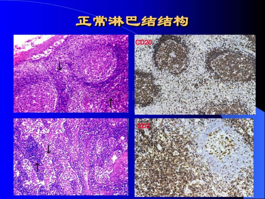 淋巴造血系统疾病3.pptx_第2页