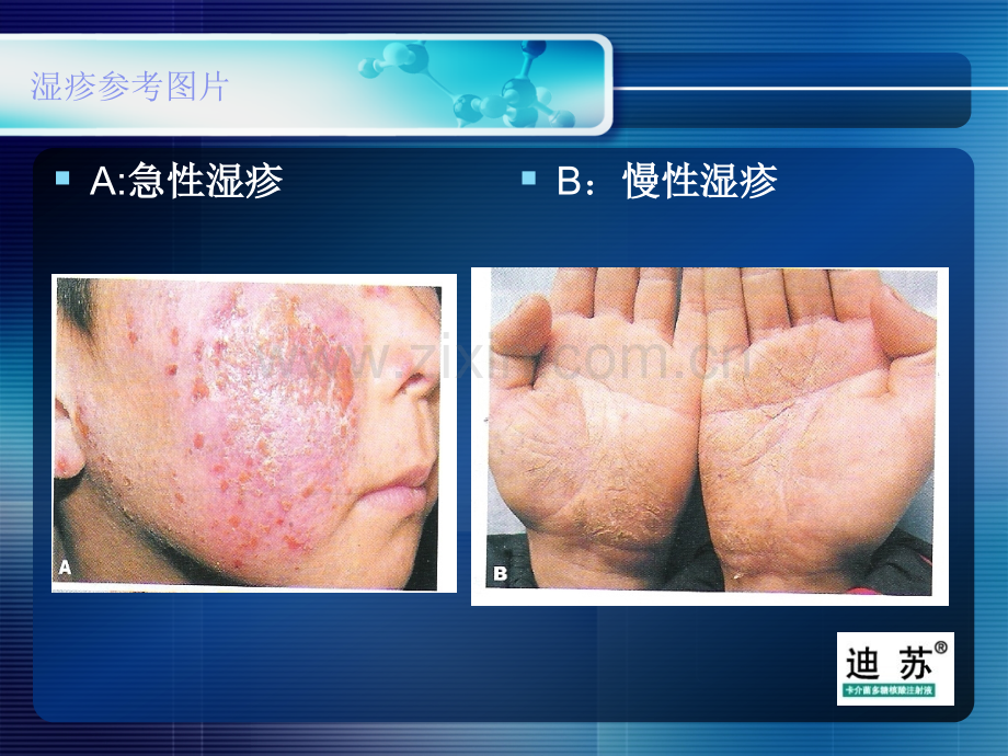 卡介菌多糖核酸有效治疗湿疹.pptx_第2页