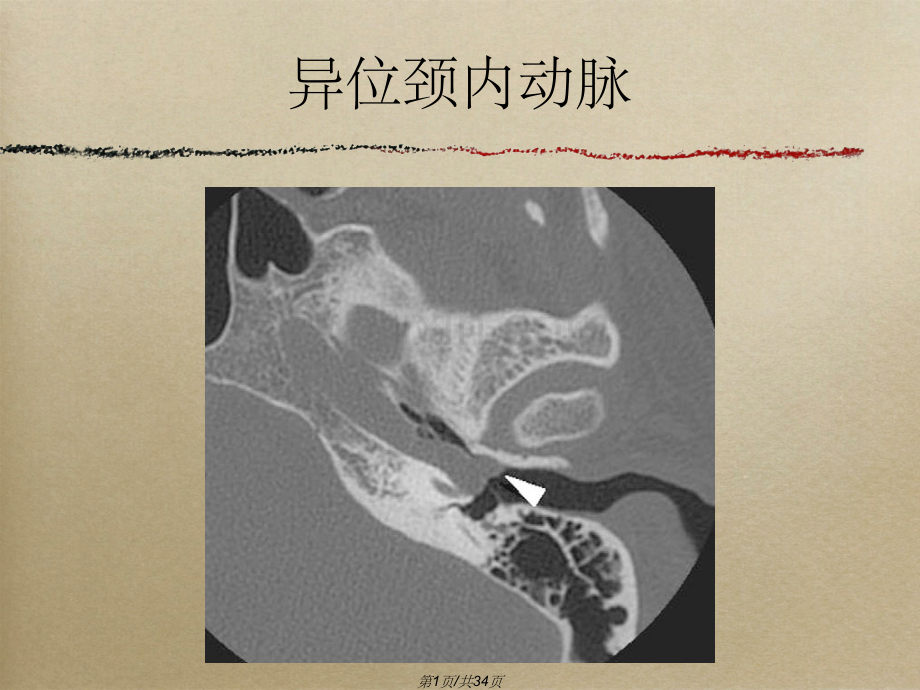 搏动性耳鸣影像表现.pptx_第1页