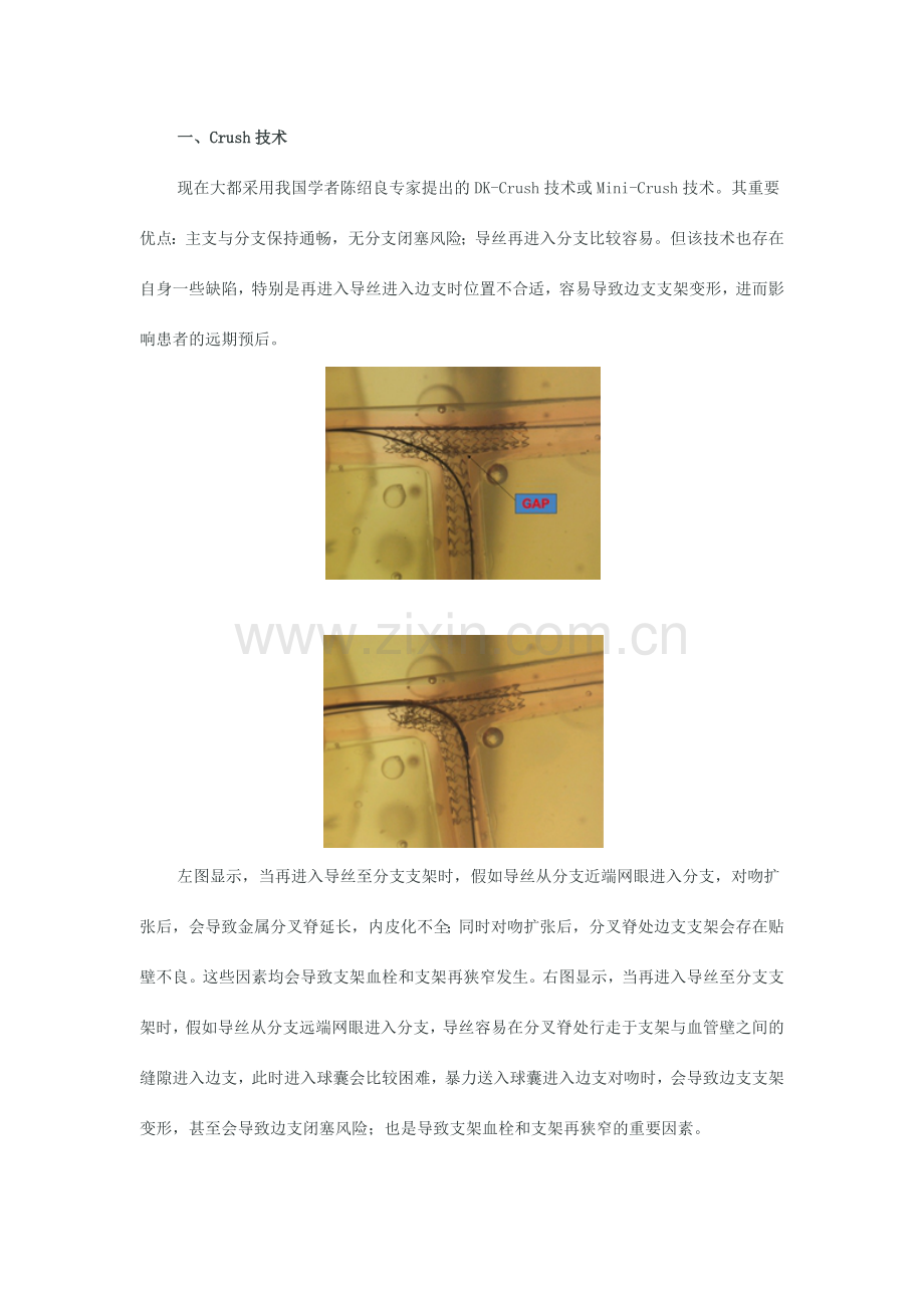 新型支架技术.docx_第1页