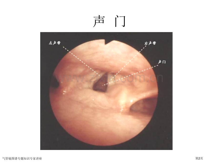气管镜图谱专题知识专家讲座.pptx_第2页