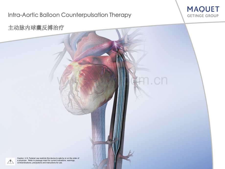 IABP操作(机器及植入).ppt_第1页