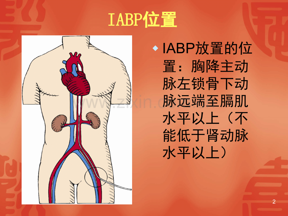 IABP的护理要点(课堂PPT).ppt_第2页