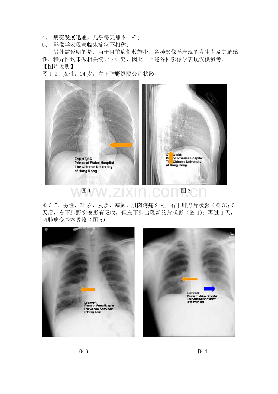 SARS的影像学表现.doc_第2页