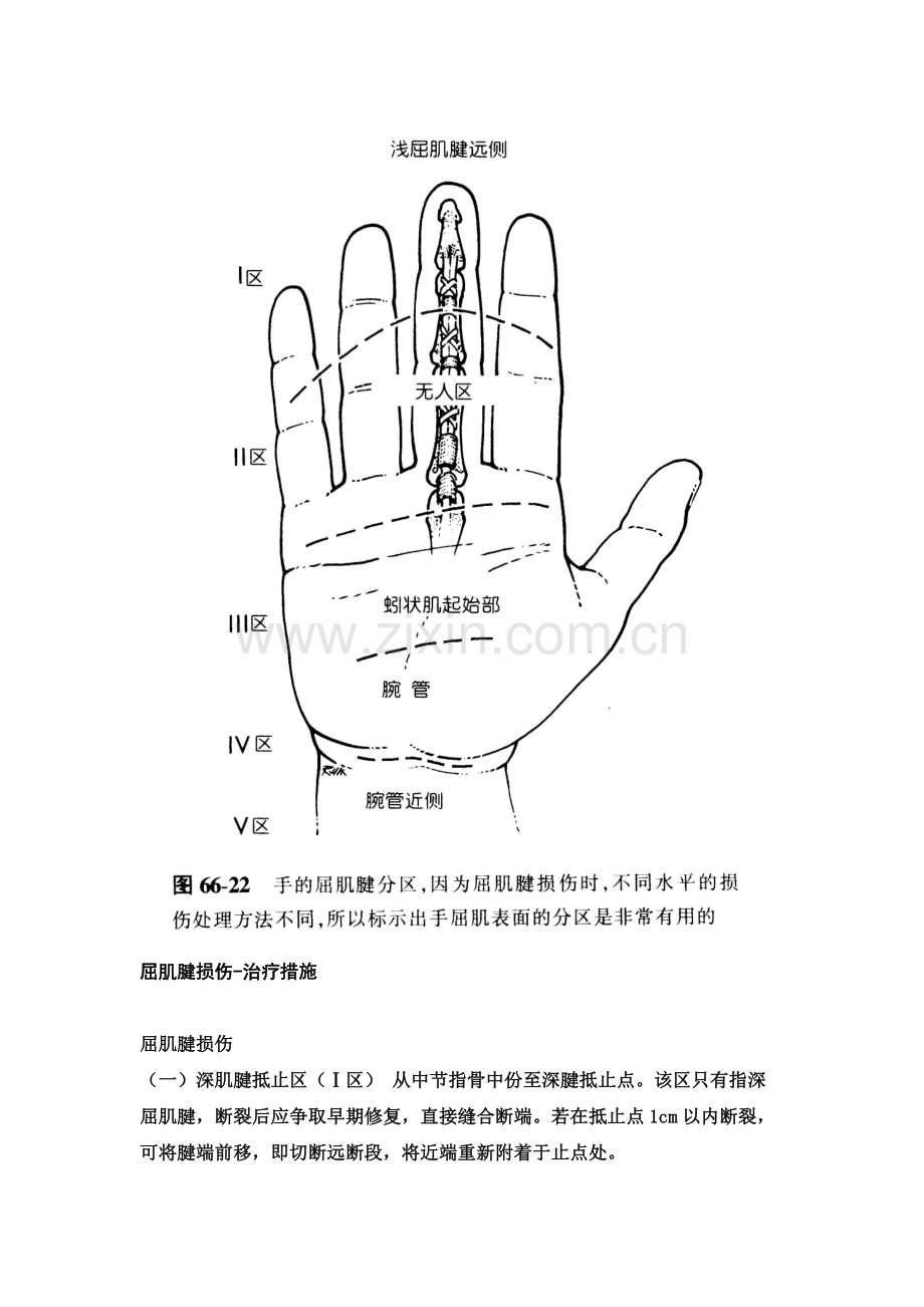 手屈肌腱分区及处理.doc_第1页