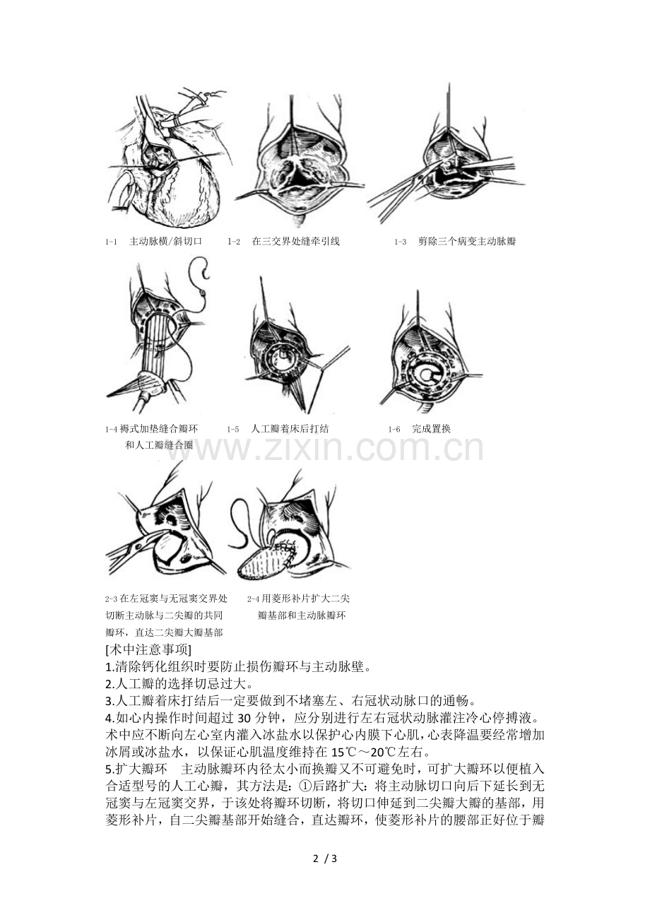 主动脉瓣置换.doc_第2页