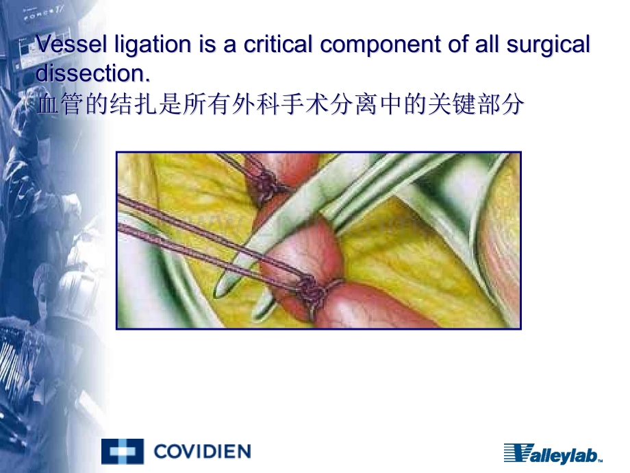 ligasuretm的临床应用.pptx_第2页